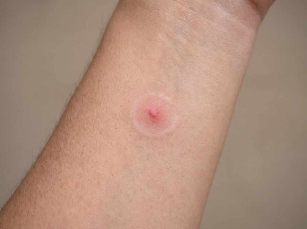 Close-up of a fresh bite site with two small red puncture marks and mild surrounding redness on skin