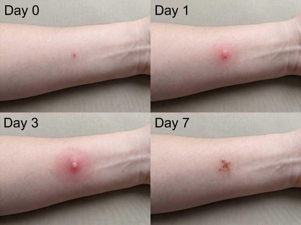 Four-panel progression photo of a black widow bite site on day zero, day one, day three, and day seven showing minimal local change